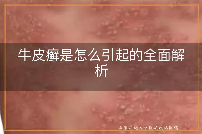 牛皮癣是怎么引起的全面解析