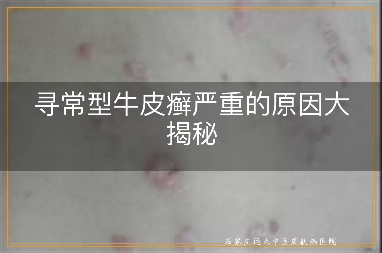 寻常型牛皮癣严重的原因大揭秘