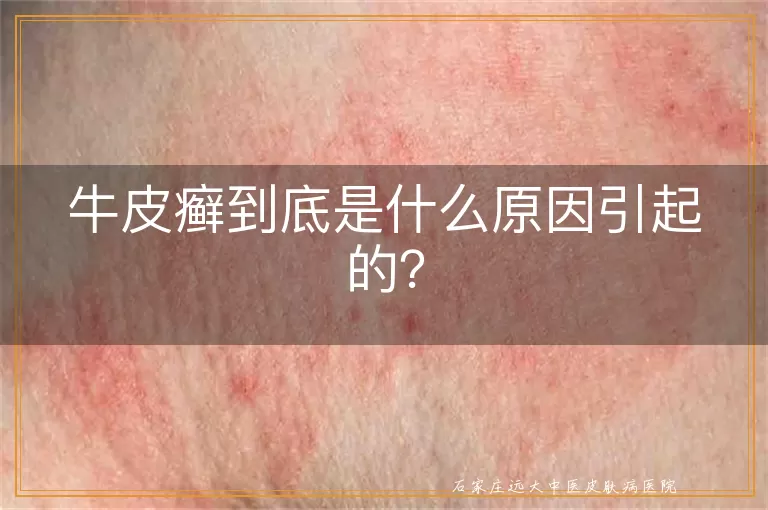 牛皮癣到底是什么原因引起的？