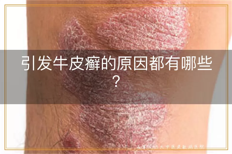 引发牛皮癣的原因都有哪些?