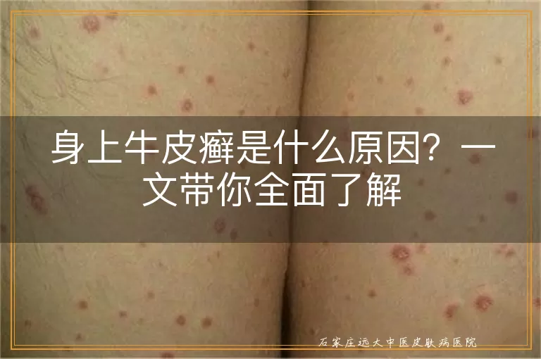 身上牛皮癣是什么原因?一文带你全面了解