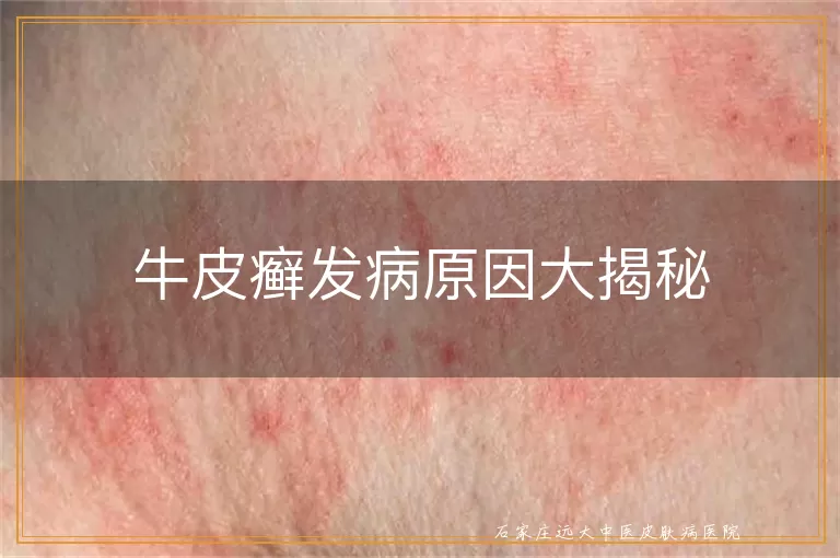 牛皮癣发病原因大揭秘