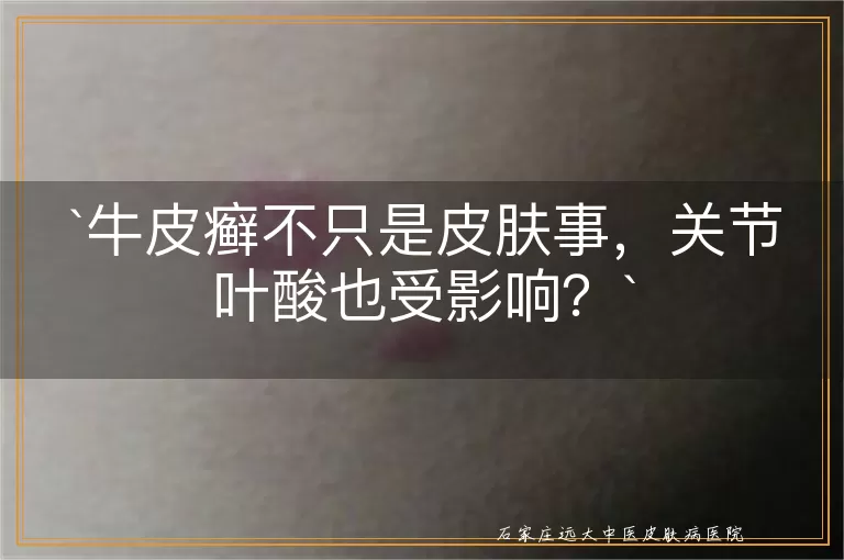 牛皮癣不只是皮肤事，关节叶酸也受影响？