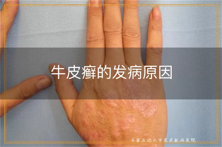 牛皮癣的发病原因