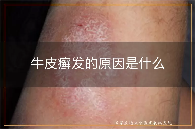 牛皮癣发的原因是什么