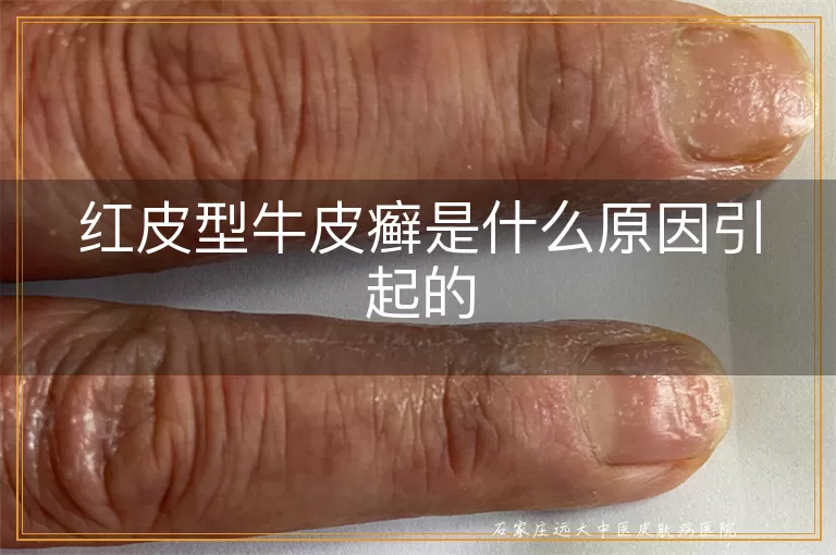 红皮型牛皮癣是什么原因引起的