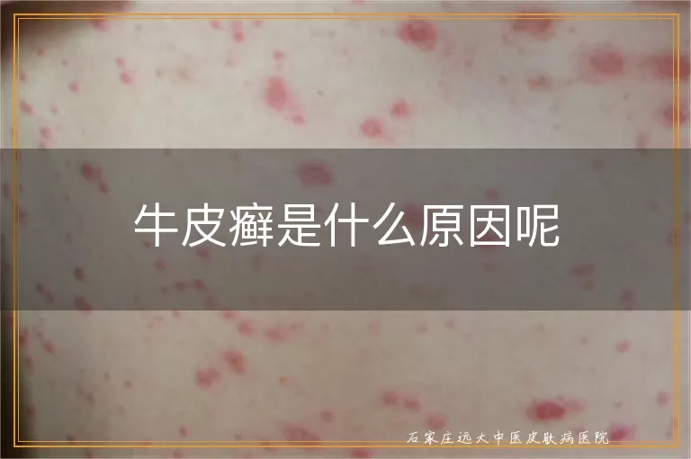 牛皮癣是什么原因呢