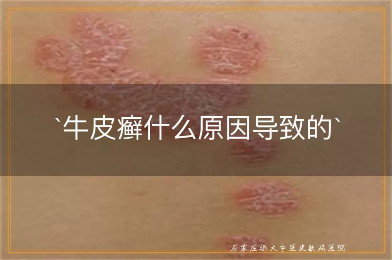 牛皮癣什么原因导致的