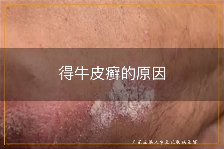 得牛皮癣的原因