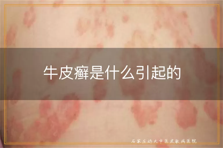 牛皮癣是什么引起的