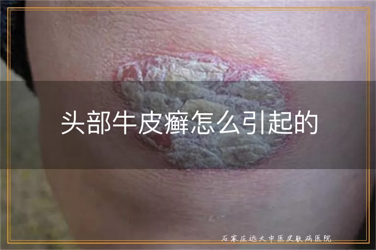 头部牛皮癣怎么引起的