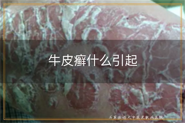 牛皮癣什么引起