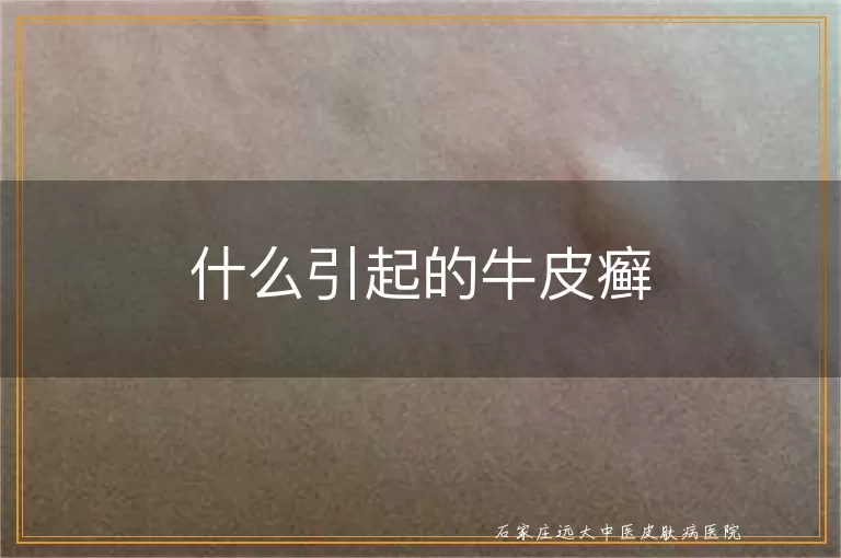 什么引起的牛皮癣