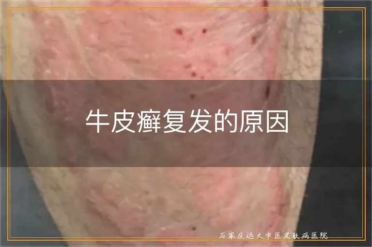 牛皮癣复发的原因