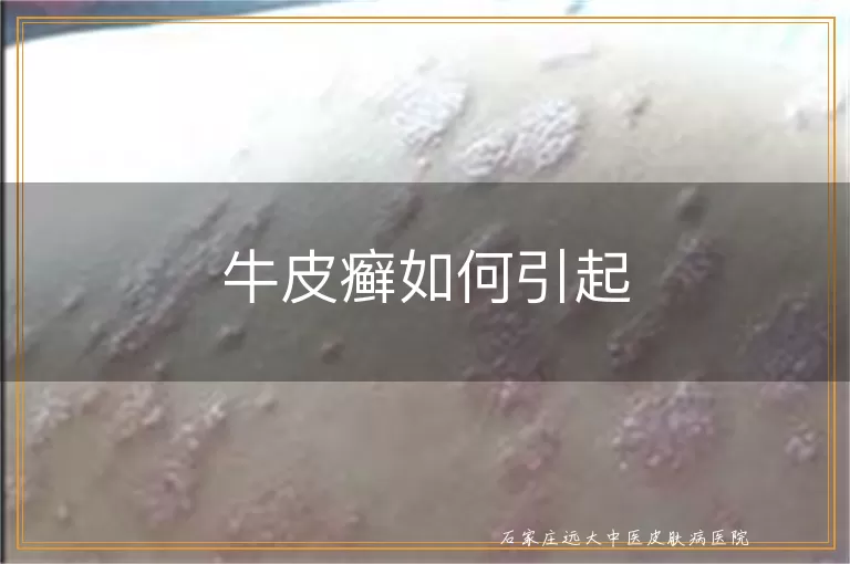 牛皮癣如何引起