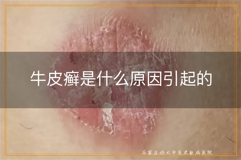 牛皮癣是什么原因引起的