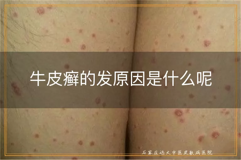 牛皮癣的发原因是什么呢