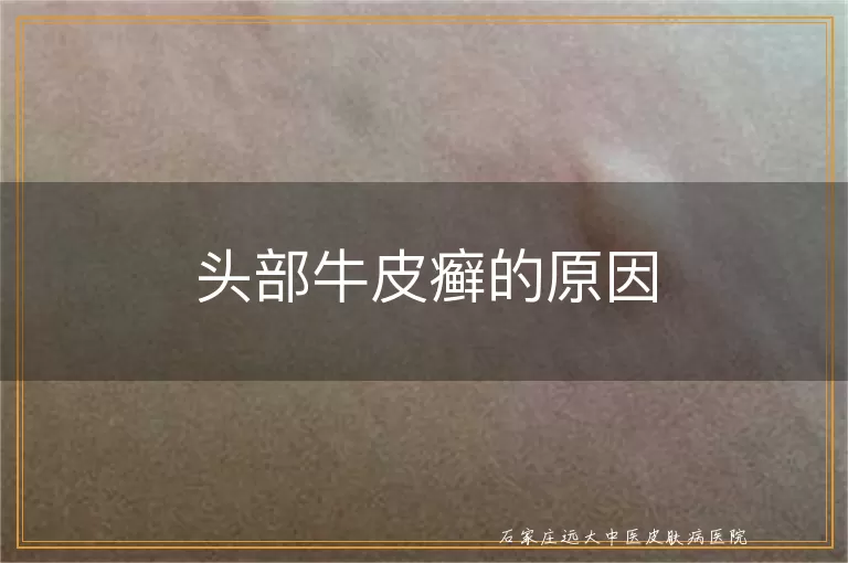 头部牛皮癣的原因