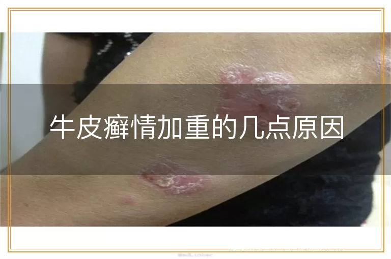 牛皮癣情加重的几点原因
