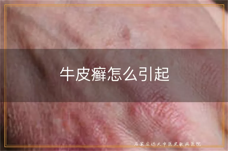 牛皮癣怎么引起