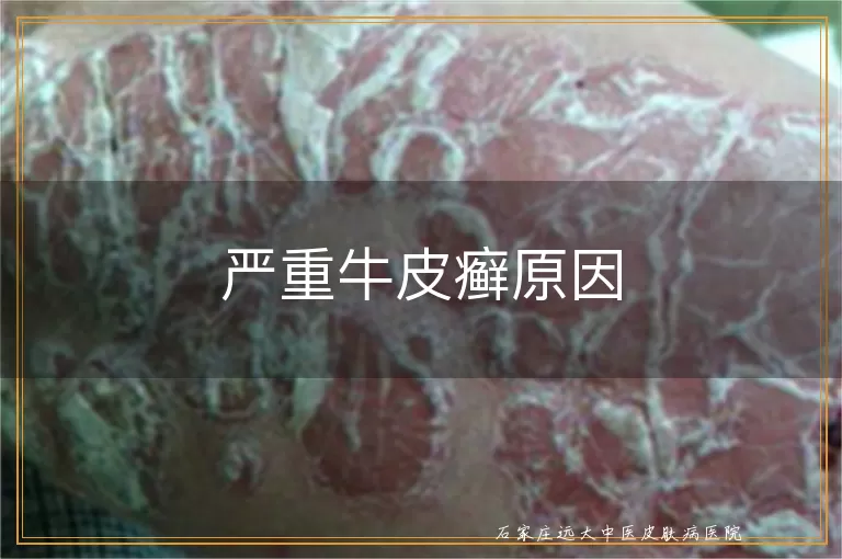 严重牛皮癣原因