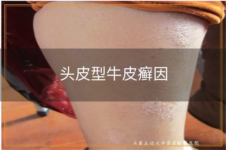 头皮型牛皮癣因