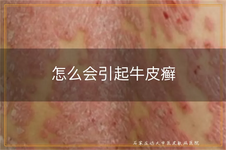 怎么会引起牛皮癣