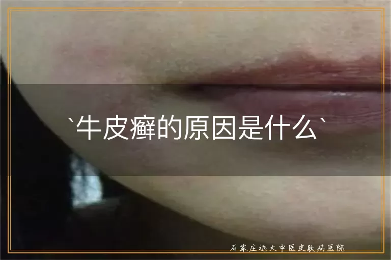 牛皮癣的原因是什么
