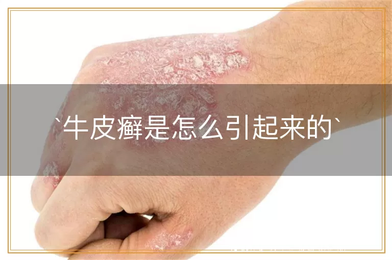 牛皮癣是怎么引起来的
