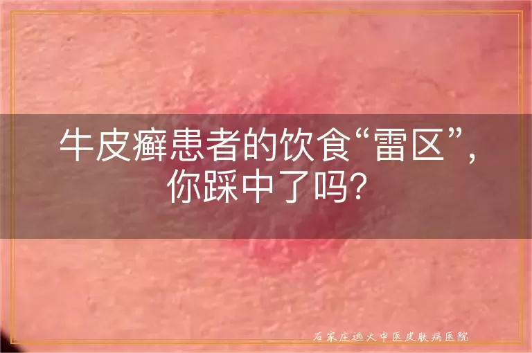 牛皮癣患者的饮食“雷区”，你踩中了吗？