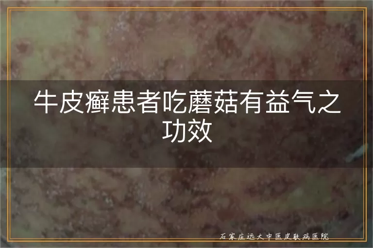 牛皮癣患者吃蘑菇有益气之功效