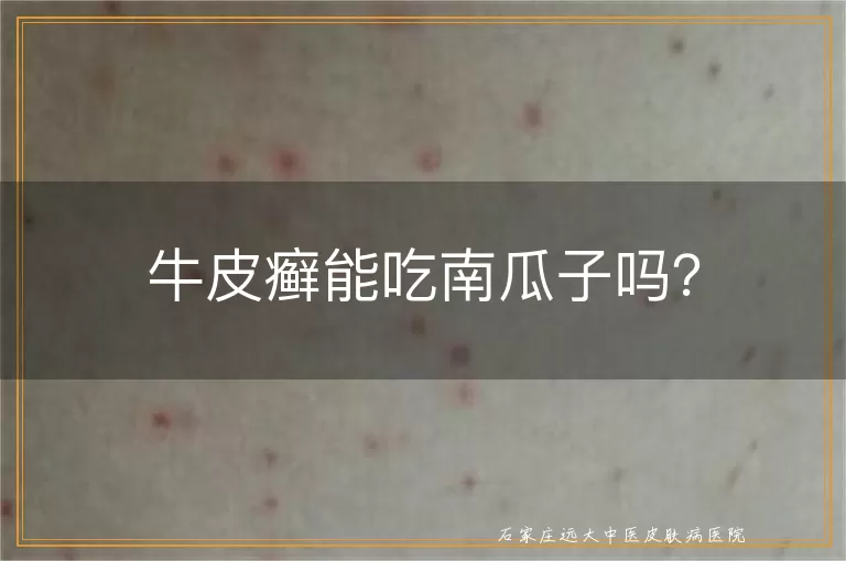 牛皮癣能吃南瓜子吗？