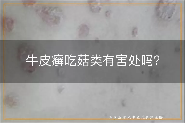 牛皮癣吃菇类有害处吗？