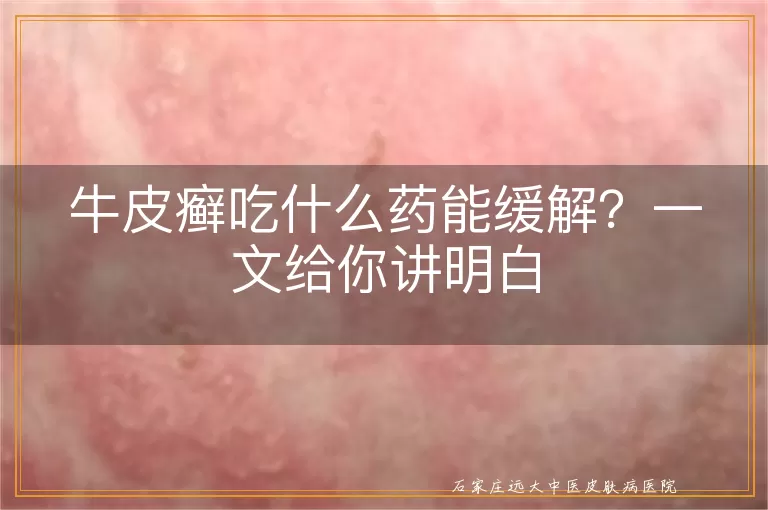 牛皮癣吃什么药能缓解？一文给你讲明白