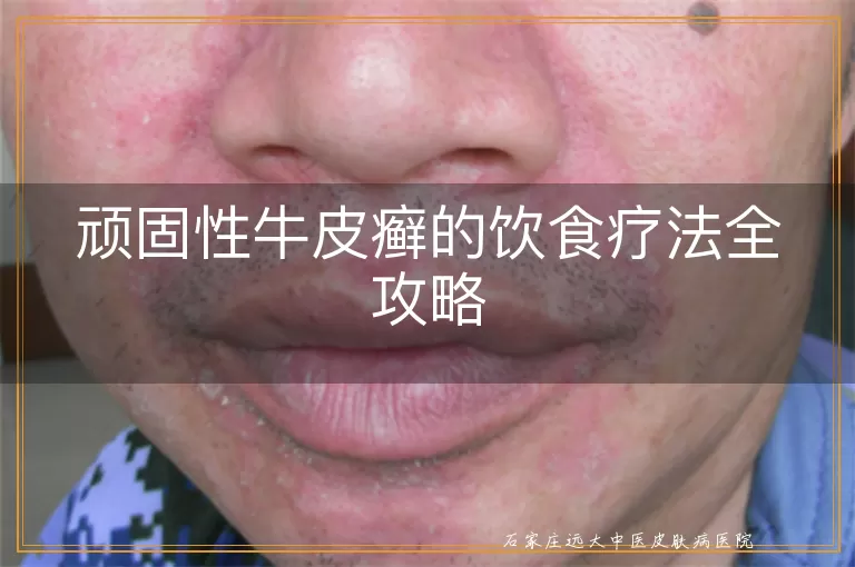 顽固性牛皮癣的饮食疗法全攻略