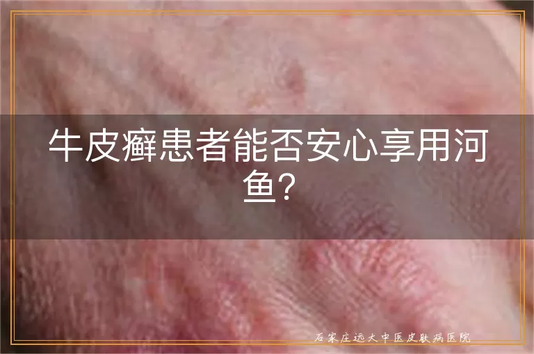 牛皮癣患者能否安心享用河鱼？