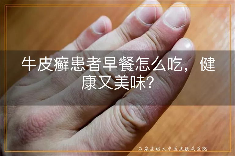 牛皮癣患者早餐怎么吃，健康又美味？