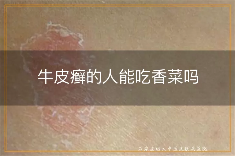 牛皮癣的人能吃香菜吗