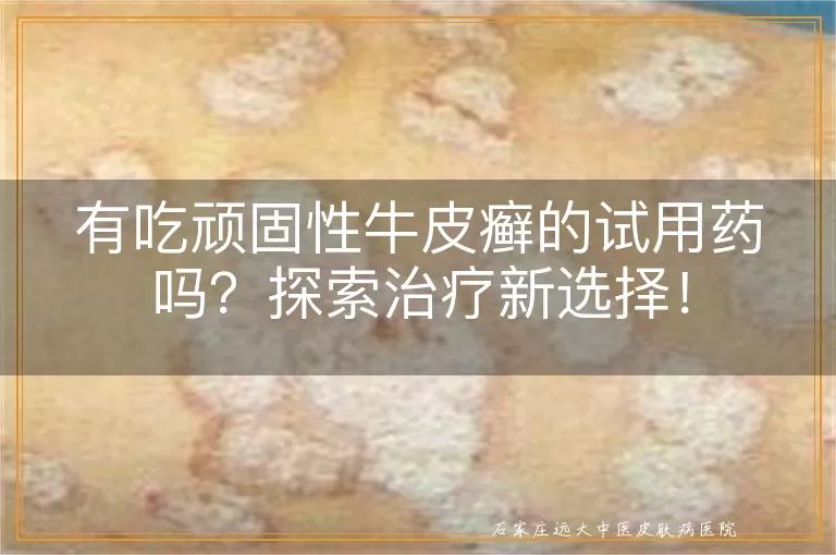 有吃顽固性牛皮癣的试用药吗？探索治疗新选择！