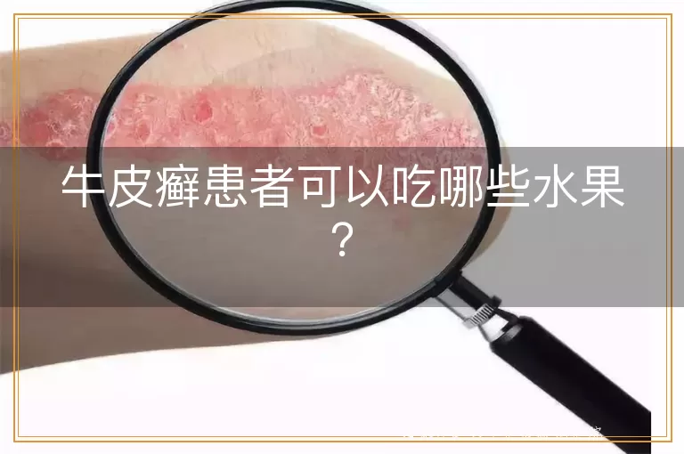 牛皮癣患者可以吃哪些水果？