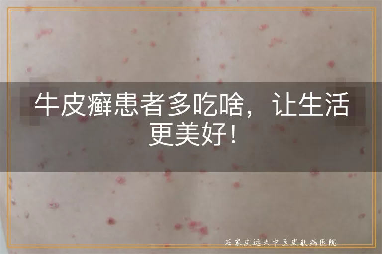 牛皮癣患者多吃啥，让生活更美好！