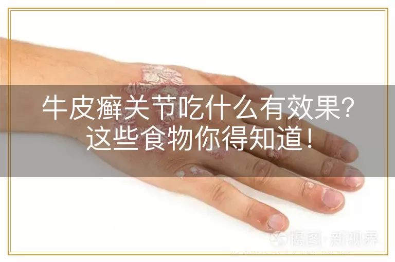 牛皮癣关节吃什么有效果？这些食物你得知道！