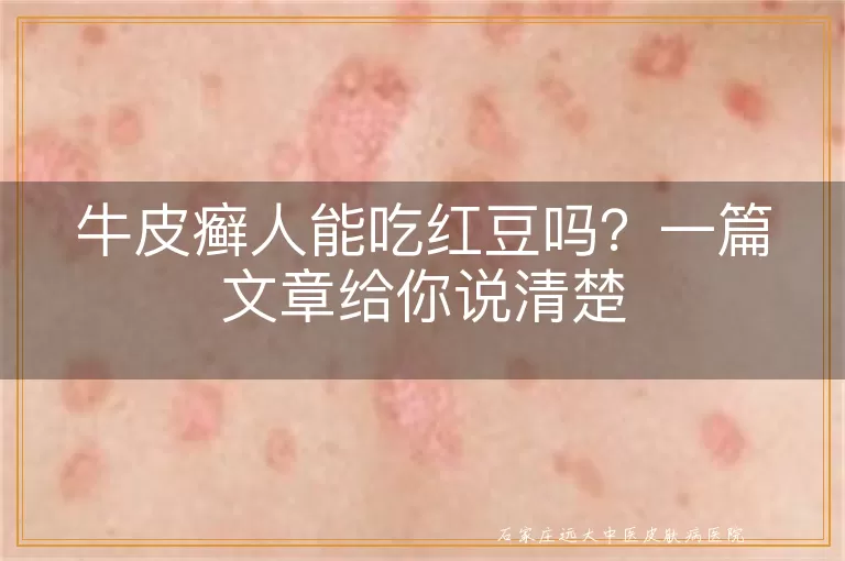 牛皮癣人能吃红豆吗？一篇文章给你说清楚