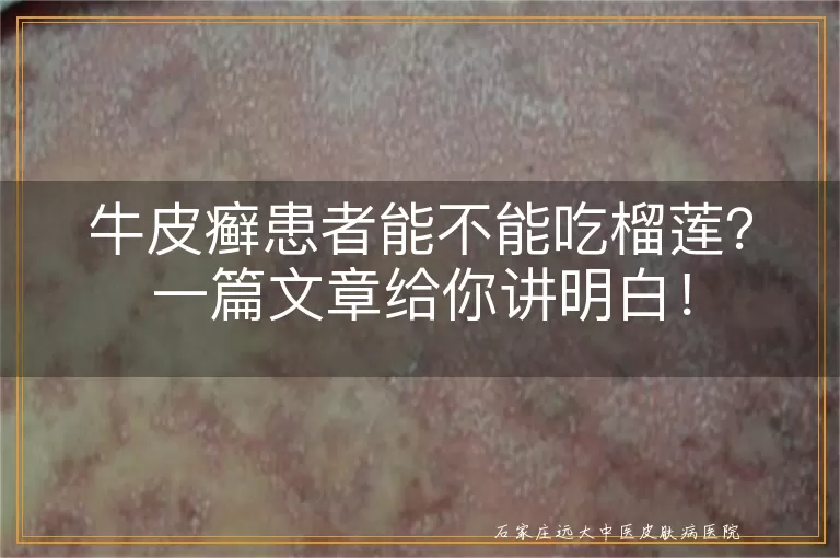 牛皮癣患者能不能吃榴莲？一篇文章给你讲明白！