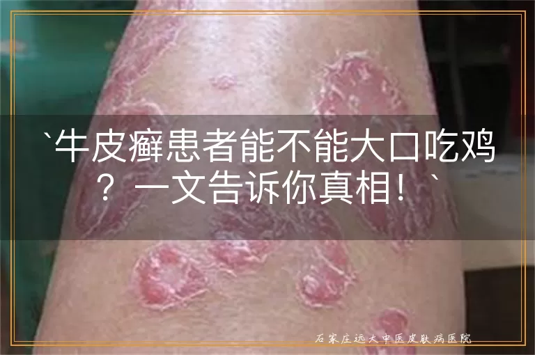 牛皮癣患者能不能大口吃鸡？一文告诉你真相！