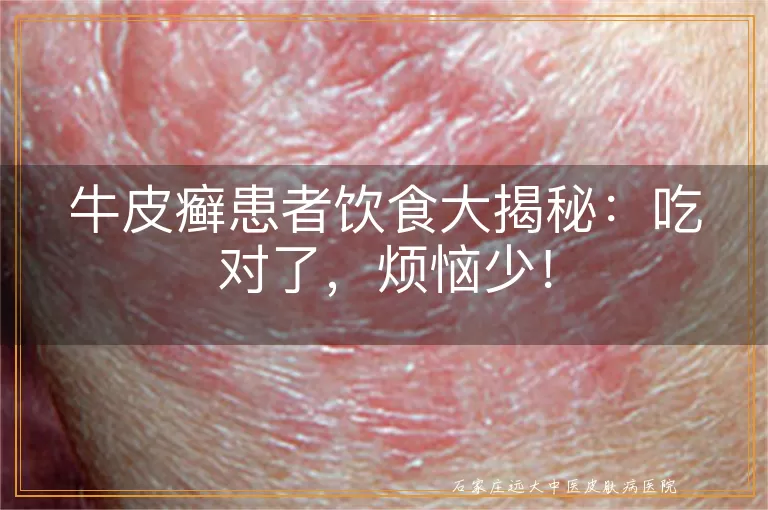 牛皮癣患者饮食大揭秘：吃对了，烦恼少！