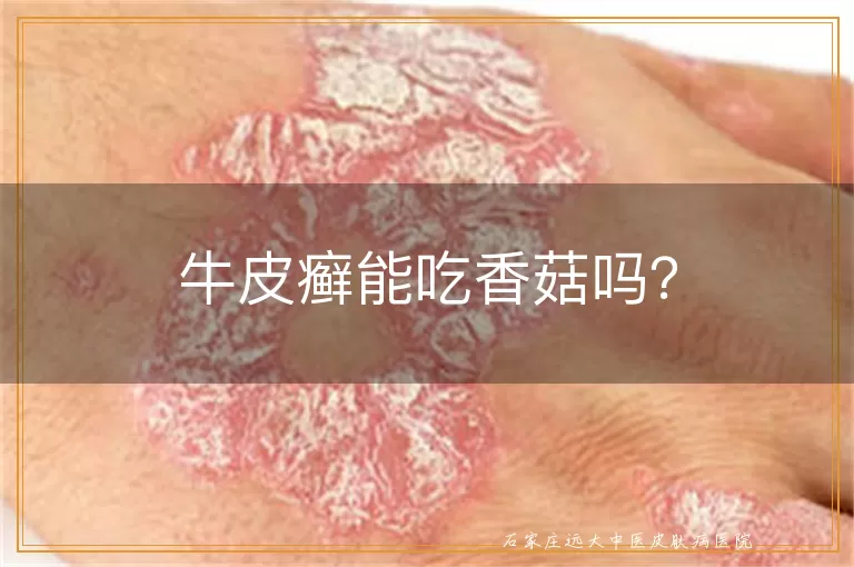 牛皮癣能吃香菇吗？