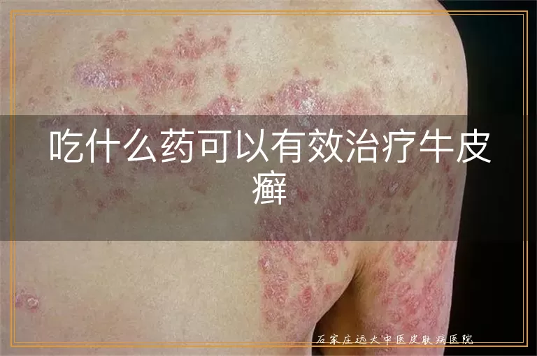 吃什么药可以有效治疗牛皮癣