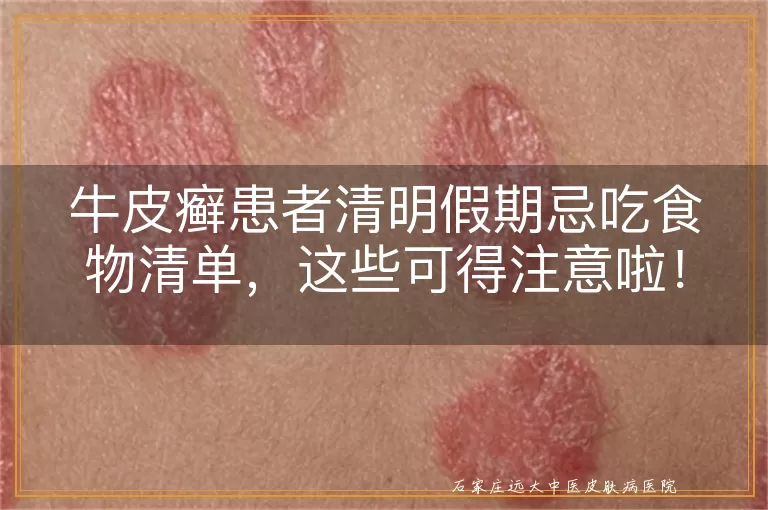 牛皮癣患者清明假期忌吃食物清单，这些可得注意啦！