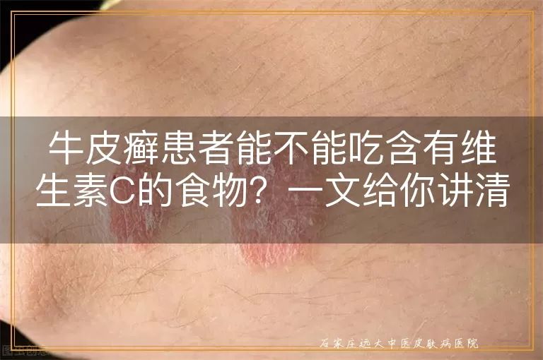 牛皮癣患者能不能吃含有维生素C的食物?一文给你讲清楚!